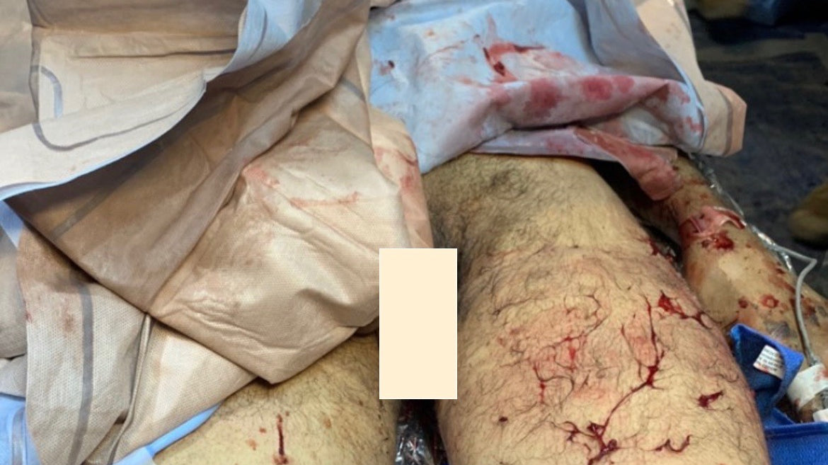 Double Amputation done by Special Forces Medic!